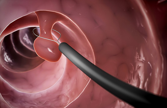 Endoscopia baja - Dra. Giovanna Parra Gil